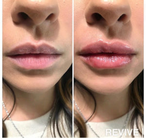 Maximizing Your Lip Filler Results: Essential Pre-and Post-Treatment  Instructions for Patients in Fargo, ND