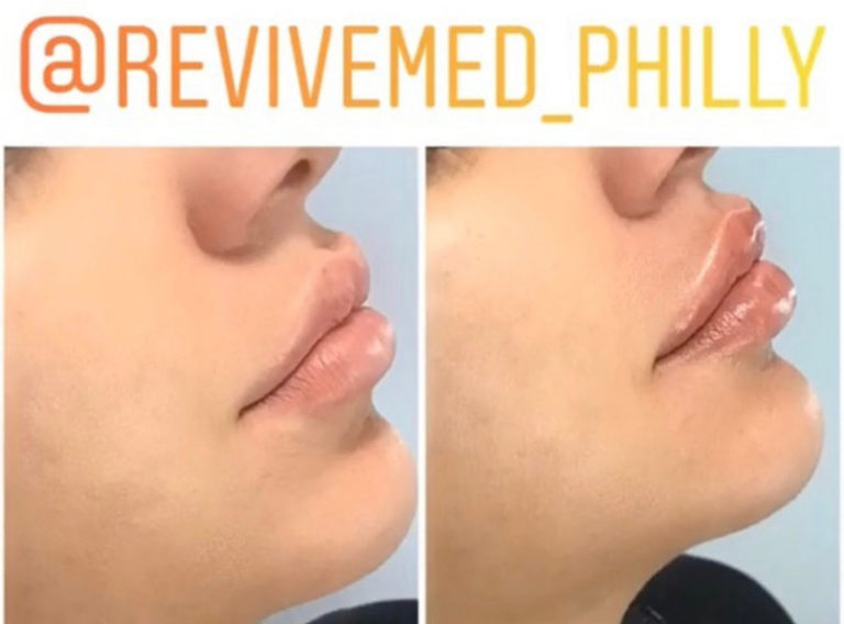 lip-filler-facts-revive-medical-philadelphia